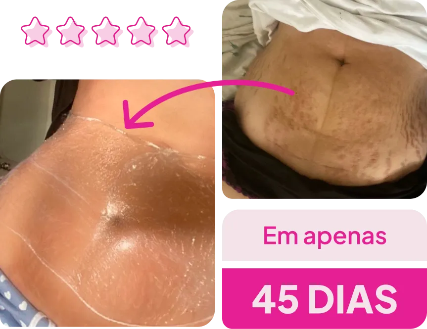 Adeus Creme Rosa para Estrias Creme Multifuncional transformação 2